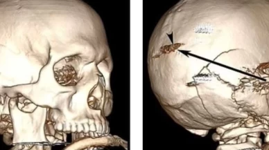 Adam, kafasına ateş açılmasının ardından tıp literatüründe eşine nadir rastlanan bir vaka olarak yerini aldı