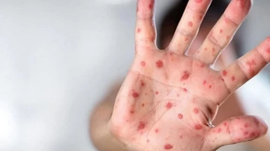 Arjantin'de Kargo Gemisinde Mpox Şüphesi: Gemi Karantinaya Alındı