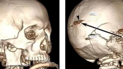 Adam, kafasına ateş açılmasının ardından tıp literatüründe eşine nadir rastlanan bir vaka olarak yerini aldı