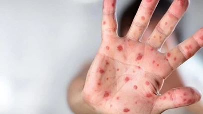 Arjantin'de Kargo Gemisinde Mpox Şüphesi: Gemi Karantinaya Alındı