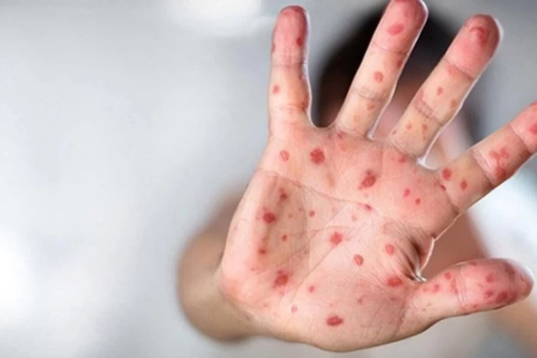 Arjantin'de Kargo Gemisinde Mpox Şüphesi: Gemi Karantinaya Alındı