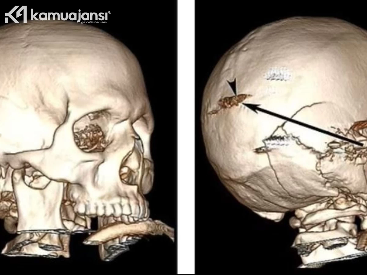 Adam, kafasına ateş açılmasının ardından tıp literatüründe eşine nadir rastlanan bir vaka olarak yerini aldı